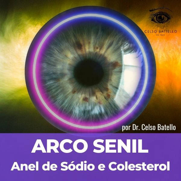 Arco Senil - Anel de sódio e colesterol